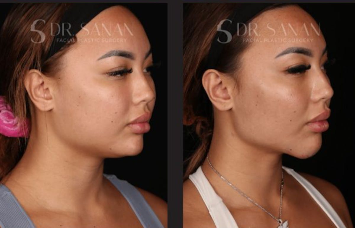 Neck Lift Before & After Gallery - Patient 893334 - Image 1