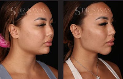 Neck Lift Before & After Gallery - Patient 893334 - Image 1