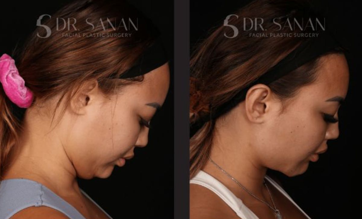 Neck Lift Before & After Gallery - Patient 893334 - Image 4