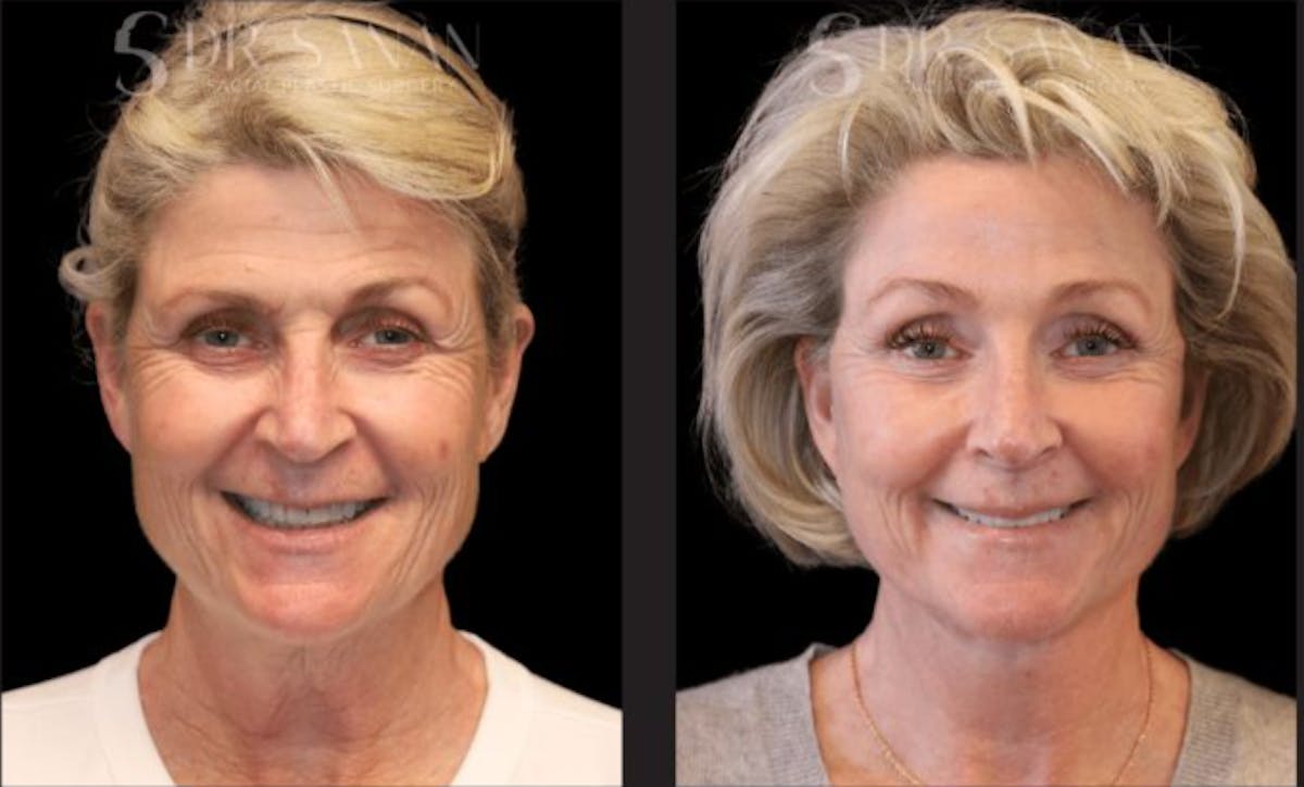 Deep Plane Facelift Before & After Gallery - Patient 315571 - Image 2