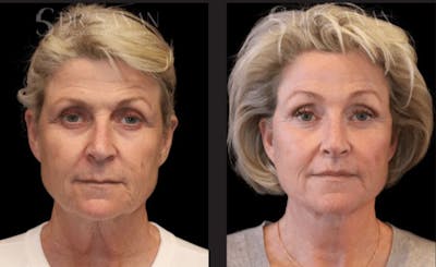 Deep Plane Facelift Before & After Gallery - Patient 315571 - Image 1