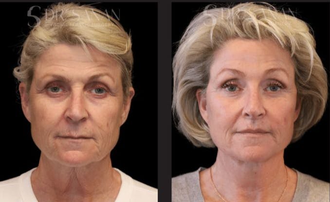 Deep Plane Facelift Before & After Gallery - Patient 315571 - Image 2