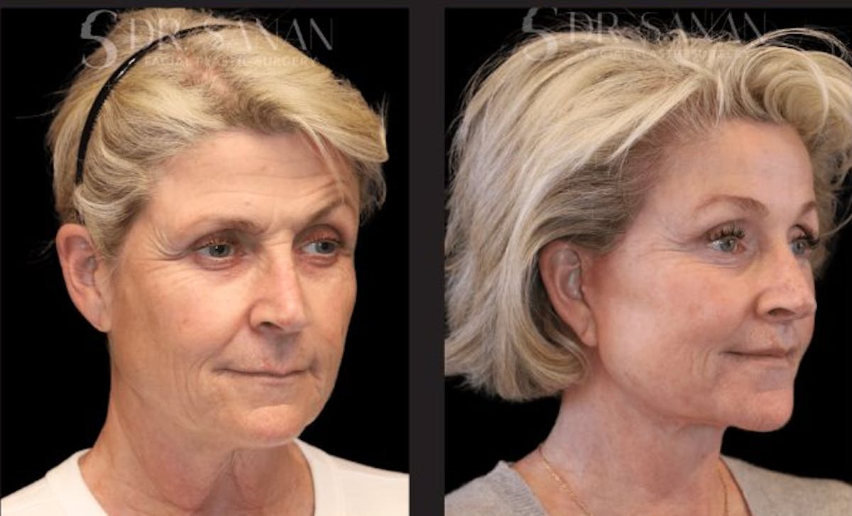 Deep Plane Facelift Before & After Gallery - Patient 315571 - Image 1