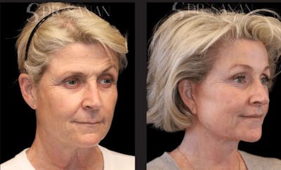 Neck Lift Before & After Gallery - Patient 428500 - Image 1