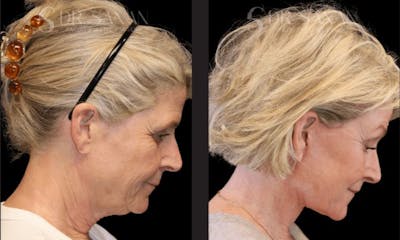 Neck Lift Before & After Gallery - Patient 428500 - Image 1