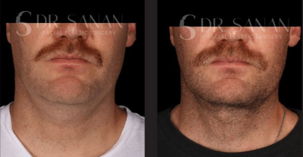 Neck Lift Before & After Gallery - Patient 670305 - Image 2