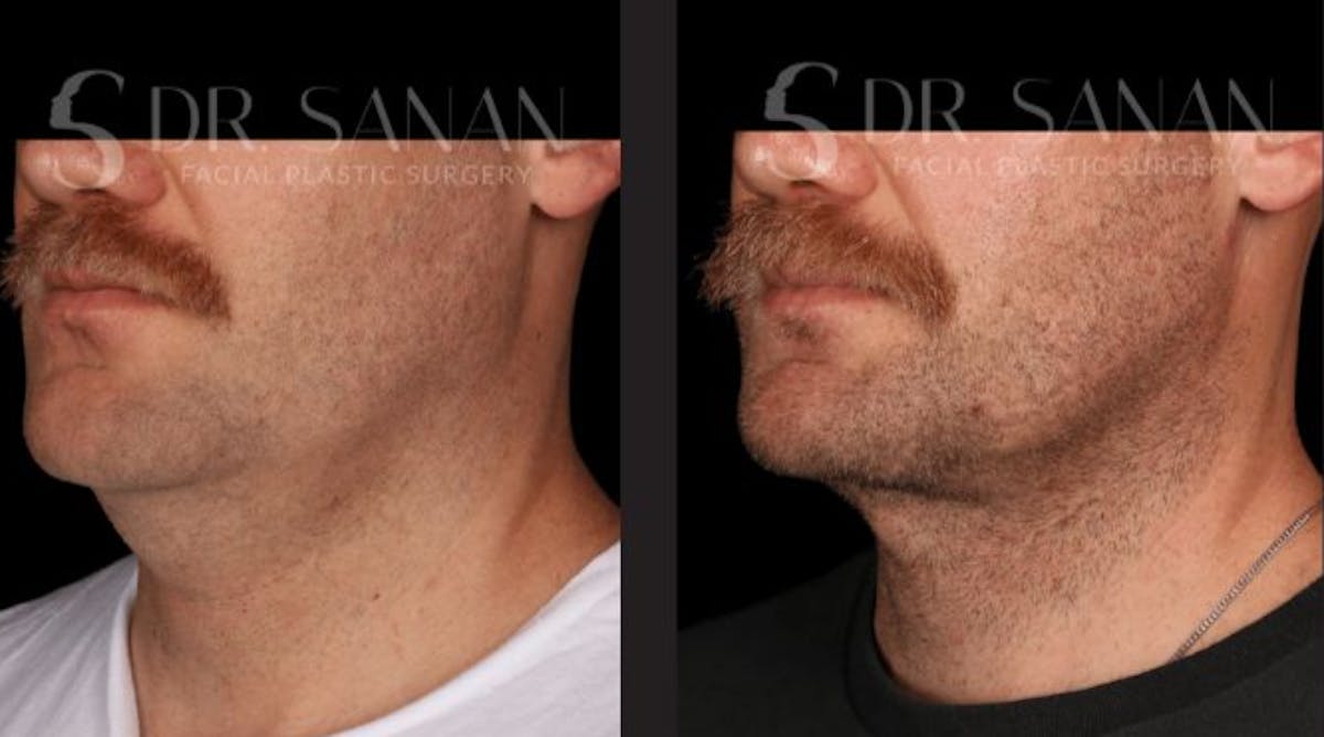 Neck Lift Before & After Gallery - Patient 670305 - Image 3