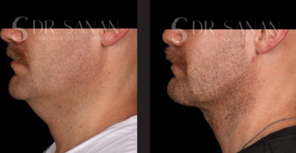 Neck Lift Before & After Gallery - Patient 670305 - Image 1