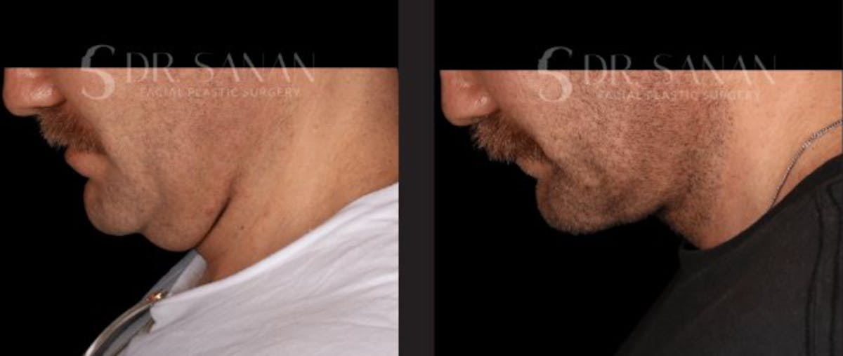 Neck Lift Before & After Gallery - Patient 670305 - Image 4