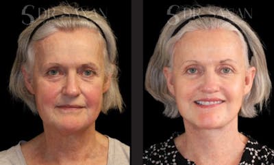 Deep Plane Facelift Before & After Gallery - Patient 228577 - Image 1