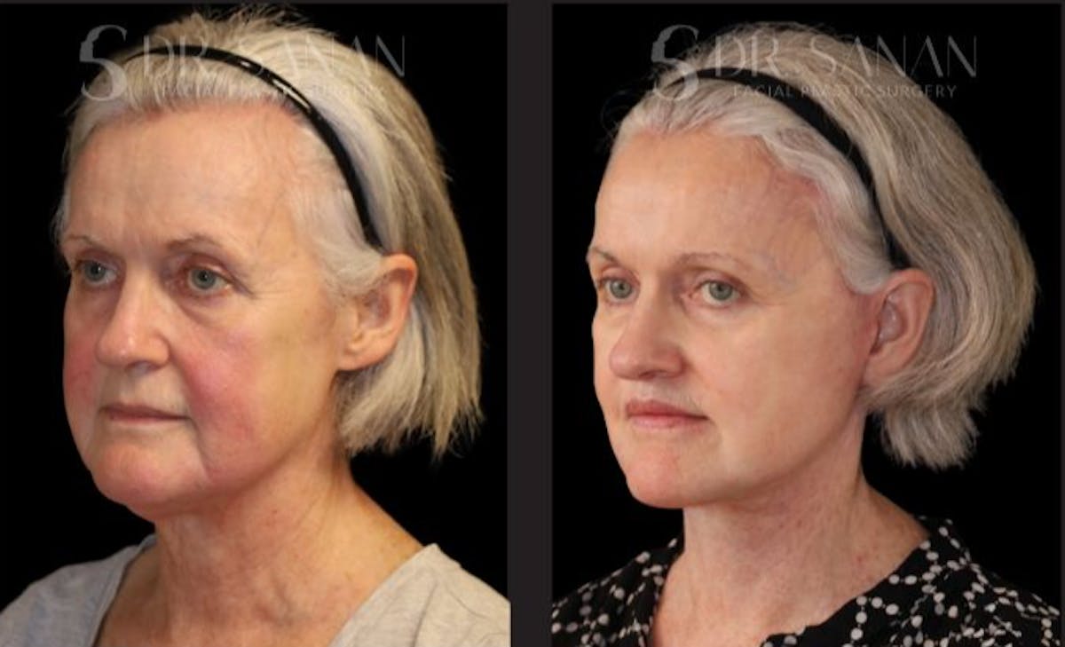 Deep Plane Facelift Before & After Gallery - Patient 228577 - Image 3
