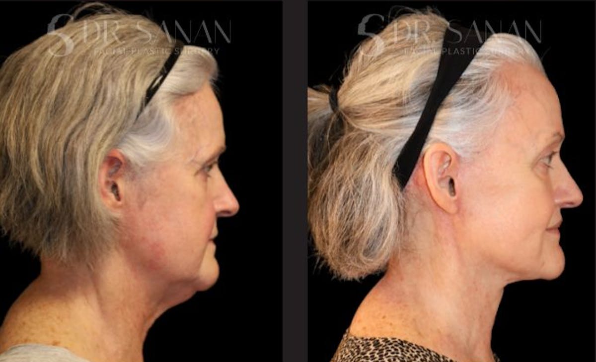 Deep Plane Facelift Before & After Gallery - Patient 228577 - Image 1
