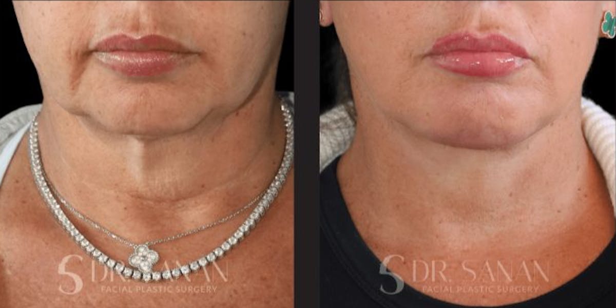 Deep Plane Facelift Before & After Gallery - Patient 181413 - Image 3