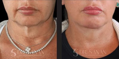 Deep Plane Facelift Before & After Gallery - Patient 181413 - Image 1