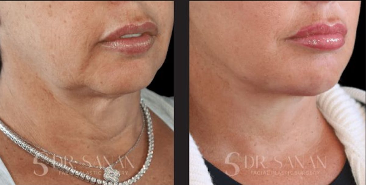 Deep Plane Facelift Before & After Gallery - Patient 181413 - Image 2