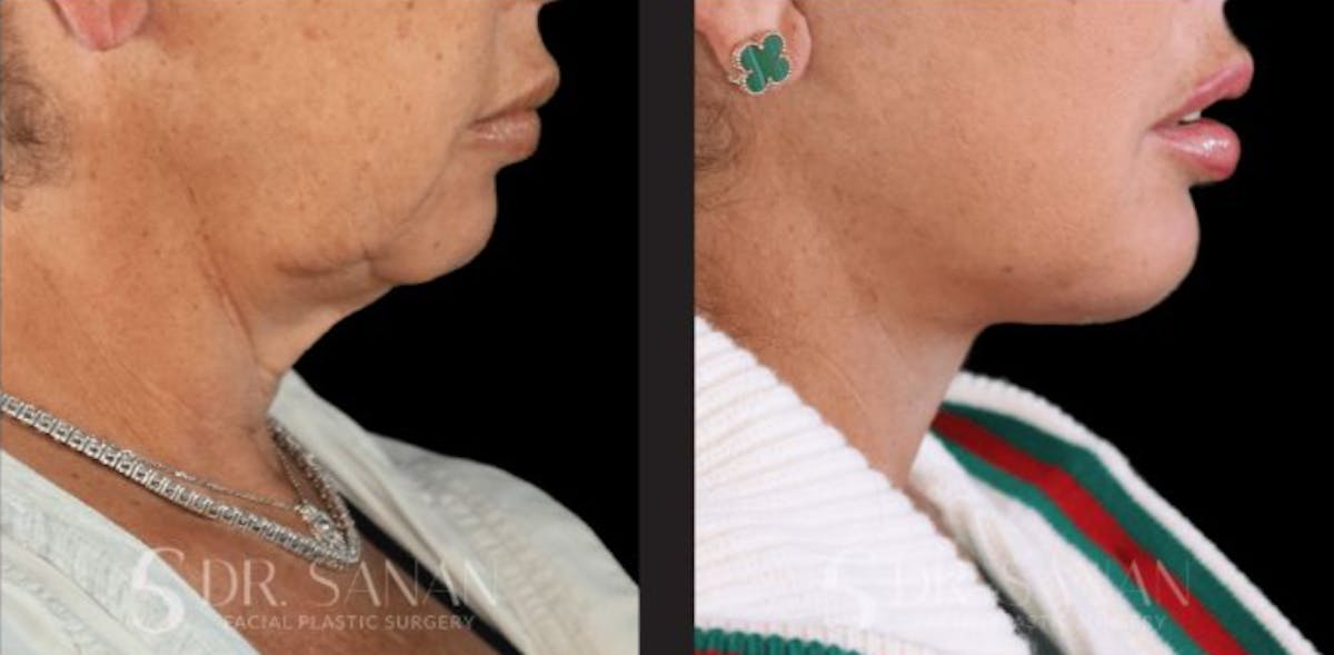 Deep Plane Facelift Before & After Gallery - Patient 181413 - Image 1