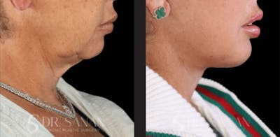 Neck Lift Before & After Gallery - Patient 201956 - Image 1