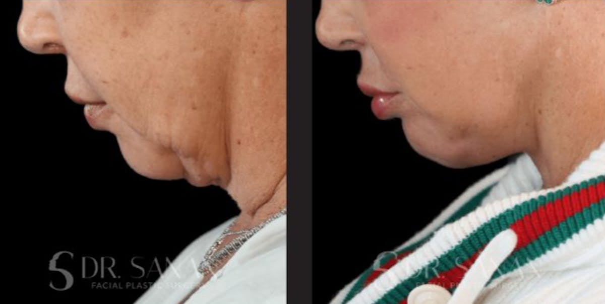 Deep Plane Facelift Before & After Gallery - Patient 181413 - Image 4