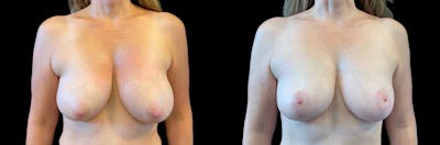 Breast Lift Before & After Gallery - Patient 109154 - Image 1