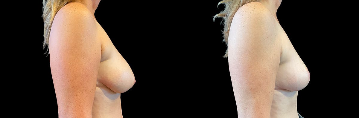 Breast Lift Before & After Gallery - Patient 109154 - Image 3