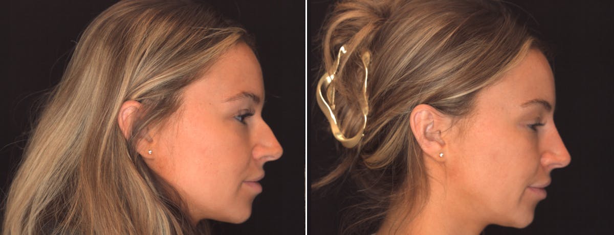 Non Surgical Rhinoplasty Before & After Gallery - Patient 263491 - Image 1