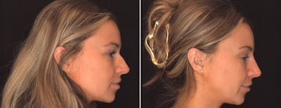 Non Surgical Rhinoplasty Before & After Gallery - Patient 263491 - Image 1