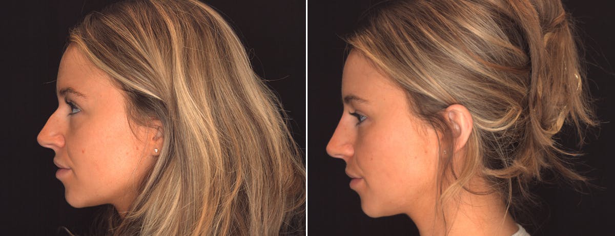 Non Surgical Rhinoplasty Before & After Gallery - Patient 263491 - Image 2