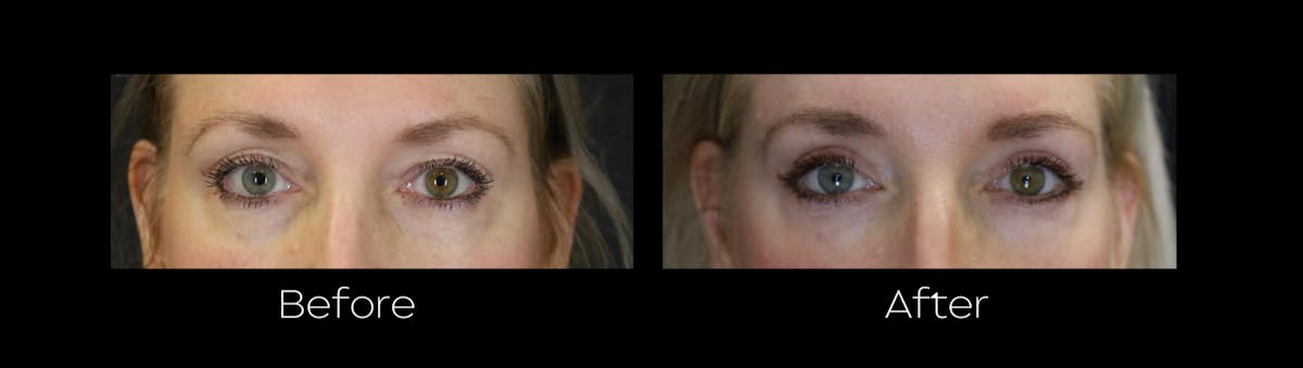 Blepharoplasty Before & After Gallery - Patient 400328 - Image 1