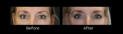 Blepharoplasty Before & After Gallery - Patient 400328 - Image 1