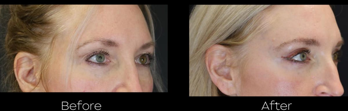 Blepharoplasty Before & After Gallery - Patient 400328 - Image 2