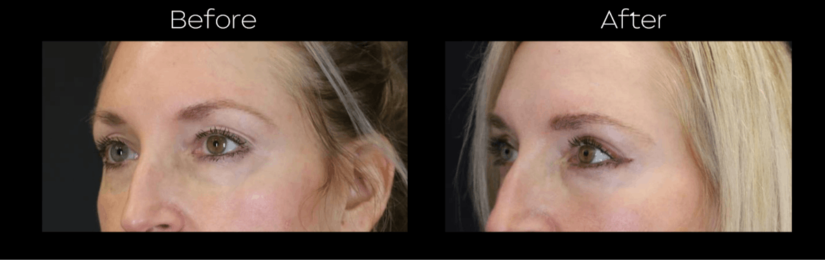 Blepharoplasty Before & After Gallery - Patient 400328 - Image 3