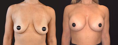 Breast Augmentation Before & After Gallery - Patient 955360 - Image 1