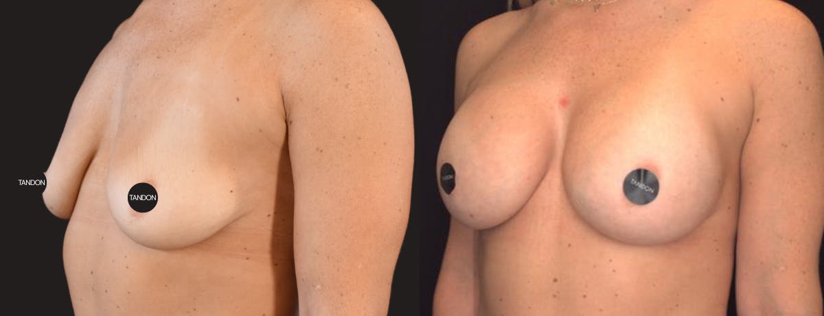 Breast Augmentation Before & After Gallery - Patient 955360 - Image 2