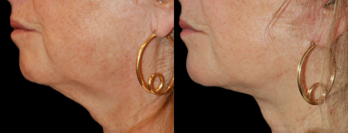Facelift Before & After Gallery - Patient 321021 - Image 2