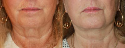 Facelift Before & After Gallery - Patient 321021 - Image 1