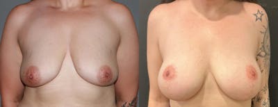 Breast Augmentation Before & After Gallery - Patient 221952 - Image 1