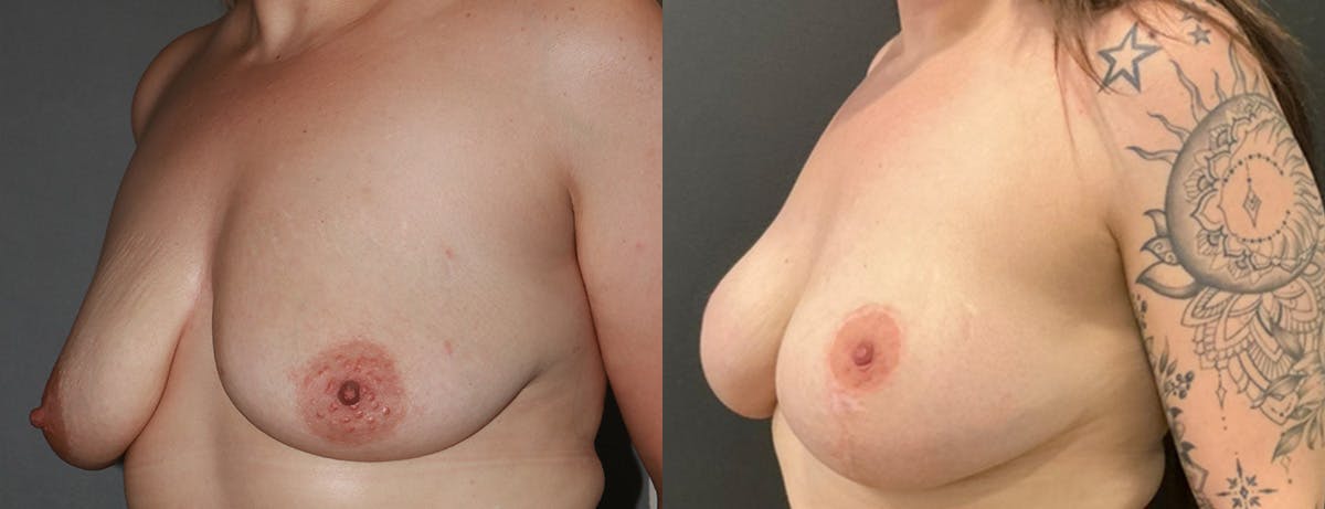 Breast Augmentation Before & After Gallery - Patient 221952 - Image 2