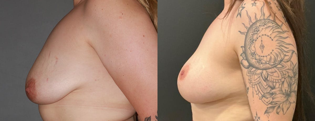 Breast Augmentation Before & After Gallery - Patient 221952 - Image 3