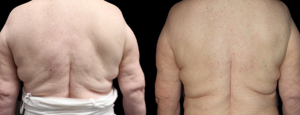 Coolsculpting Before & After Gallery - Patient 172411 - Image 1