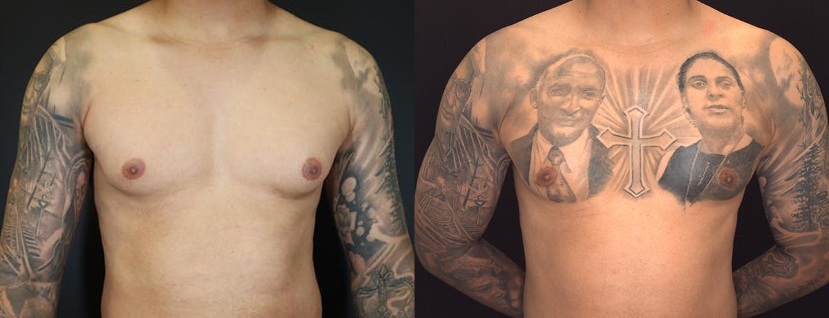 Male Breast Reduction (Gynecomastia) Before & After Gallery - Patient 957231 - Image 1