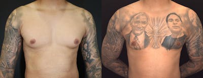 Male Breast Reduction (Gynecomastia) Before & After Gallery - Patient 957231 - Image 1