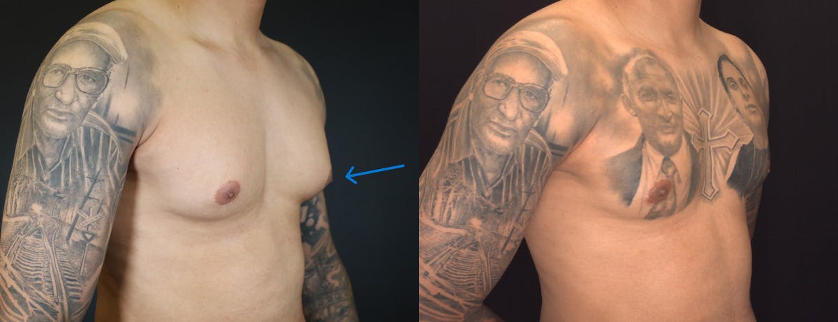 Male Breast Reduction (Gynecomastia) Before & After Gallery - Patient 957231 - Image 2