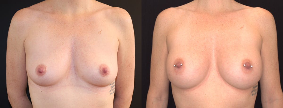 Breast Augmentation Before & After Gallery - Patient 410813 - Image 1