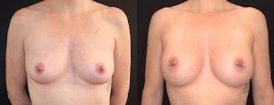 Breast Augmentation Before & After Gallery - Patient 410813 - Image 1