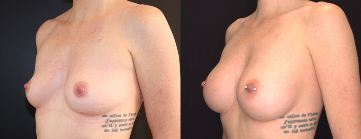 Breast Augmentation Before & After Gallery - Patient 410813 - Image 2