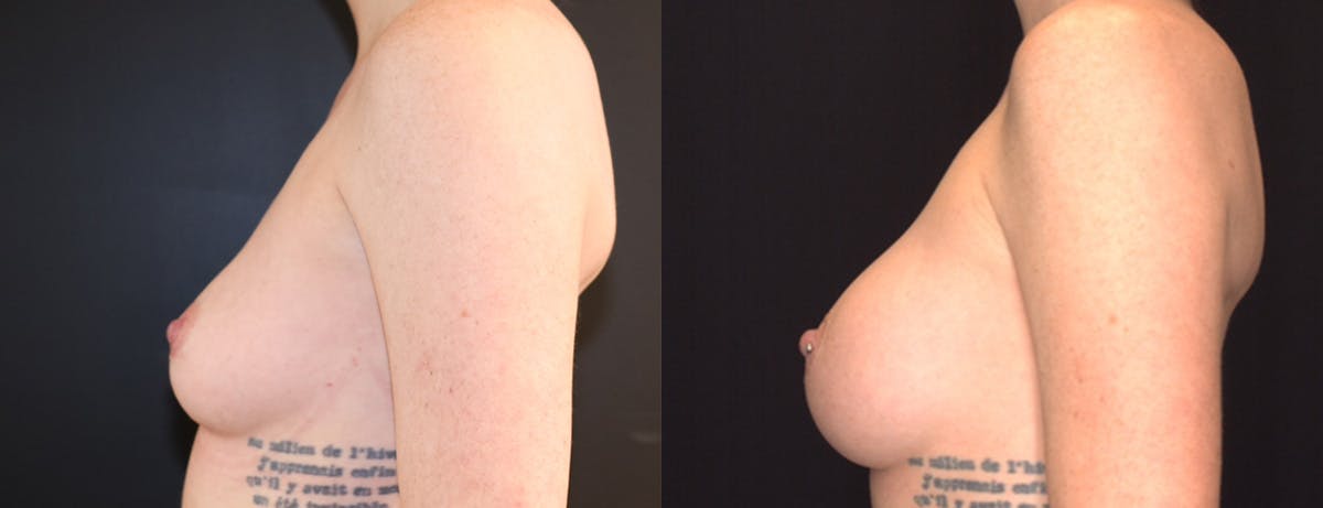 Breast Augmentation Before & After Gallery - Patient 410813 - Image 3