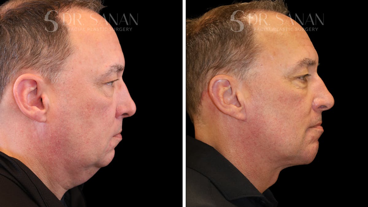Deep Plane Facelift Before & After Gallery - Patient 266643 - Image 3