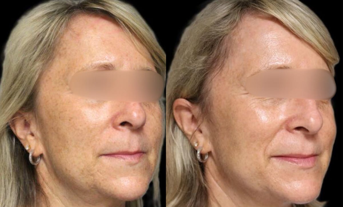 Pico Laser Before & After Gallery - Patient 326159 - Image 1