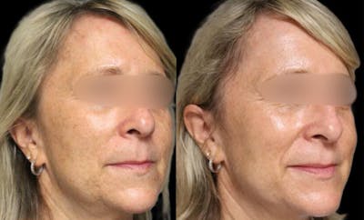 Pico Laser Before & After Gallery - Patient 326159 - Image 1