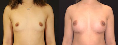 Breast Augmentation Before & After Gallery - Patient 410813 - Image 1